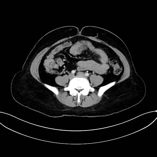 File:Adrenocortical carcinoma (Radiopaedia 87281-103569 Axial C+ portal venous phase 57).jpg