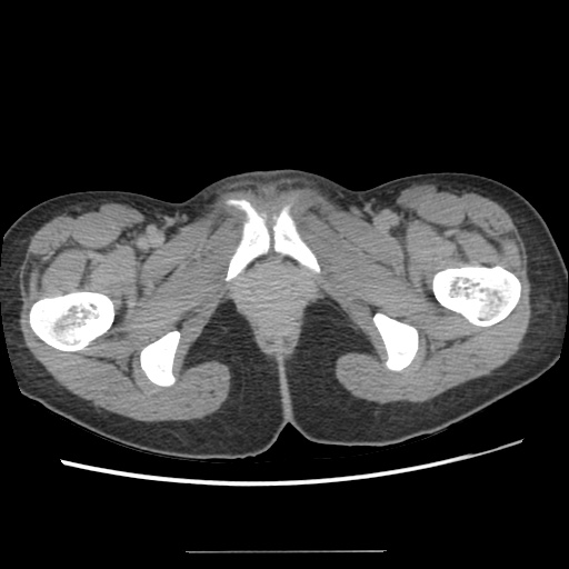 File:Adult polycystic kidney disease (Radiopaedia 48845-53876 Axial renal excretory phase 101).jpg