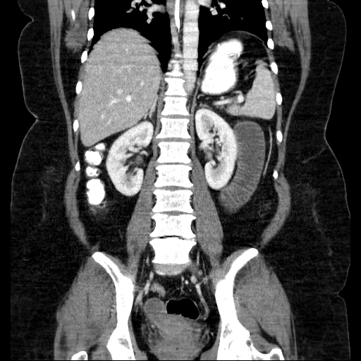 File:Afferent loop syndrome - secondary to incarcerated trocar site hernia (Radiopaedia 82959-97305 Coronal C+ portal venous phase 98).jpg