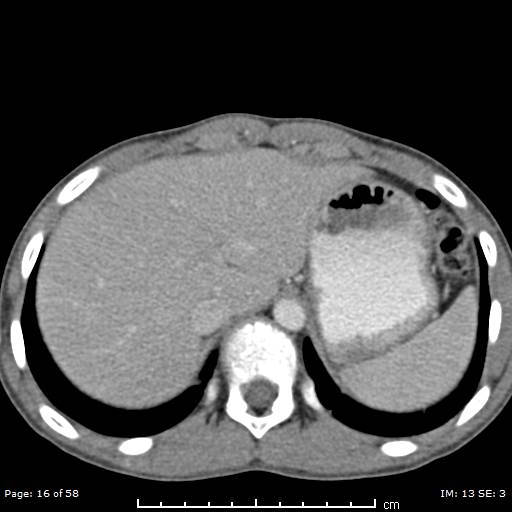 Agenesis of the gallbladder (Radiopaedia 55454-61905 B 16).jpg