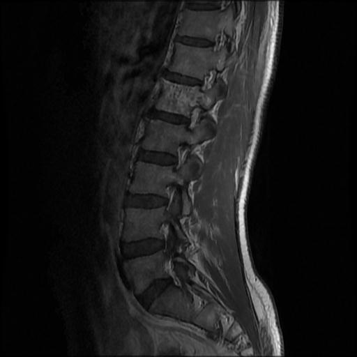 File:Aggressive vertebral hemangioma with pathological fracture (Radiopaedia 69528-79411 Sagittal T1 C+ 8).jpg