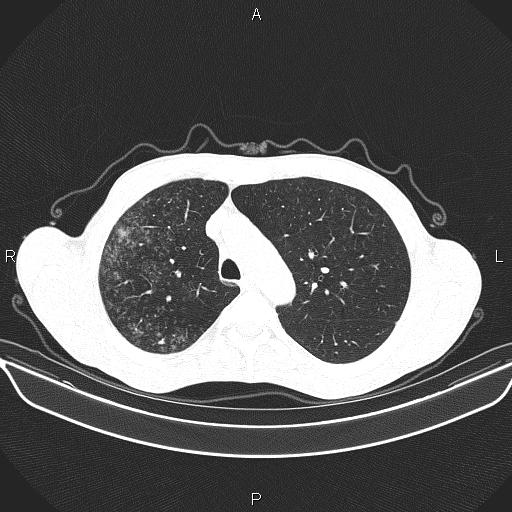 File:Air bronchogram in pneumonia (Radiopaedia 85719-101512 Axial lung window 20).jpg