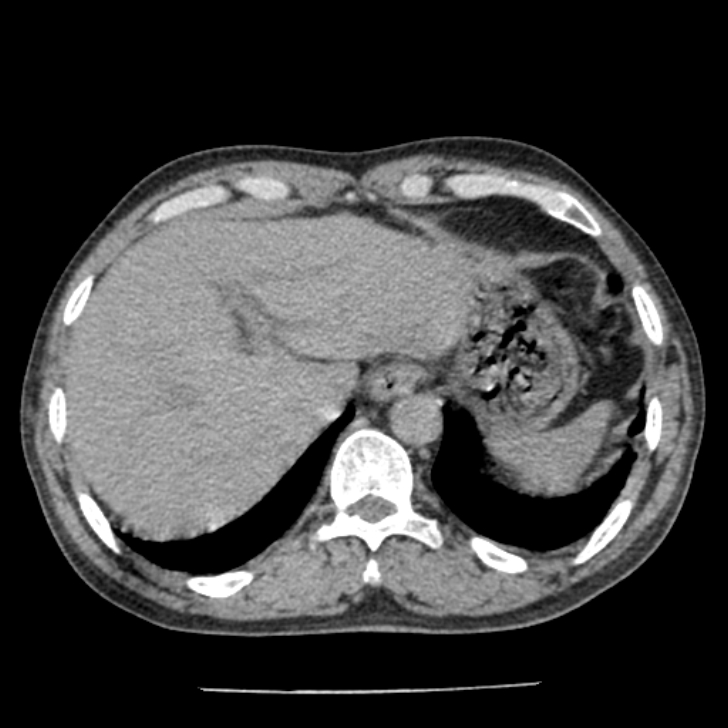 Airway foreign body in adult (Radiopaedia 85907-101779 Axial liver window 178).jpg