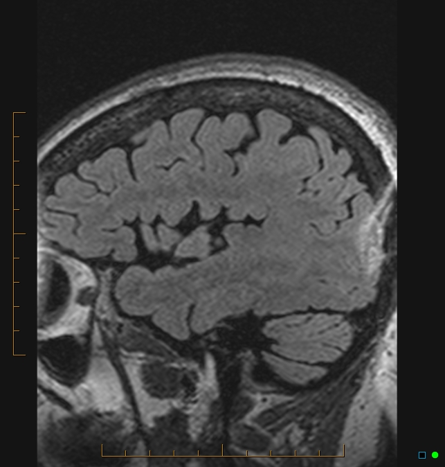 Aliasing artifact causing a spurious cerebellar lesion (Radiopaedia 48783-53810 Sagittal FLAIR 109).jpg