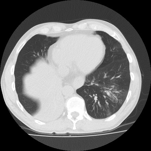 Allergic bronchopulmonary aspergillosis (ABPA) (Radiopaedia 60594-68313 Axial lung window 44).jpg