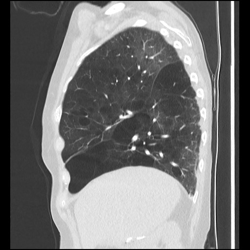 Alpha-1-antitrypsin deficiency (Radiopaedia 64893-73840 Sagittal lung window 15).jpg