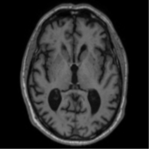 File:Alzheimer's disease- with Gerstmann syndrome and dressing apraxia (Radiopaedia 54882-61150 Axial T1 37).png