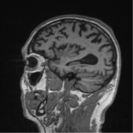 Alzheimer's disease- with Gerstmann syndrome and dressing apraxia (Radiopaedia 54882-61150 Sagittal T1 53).png