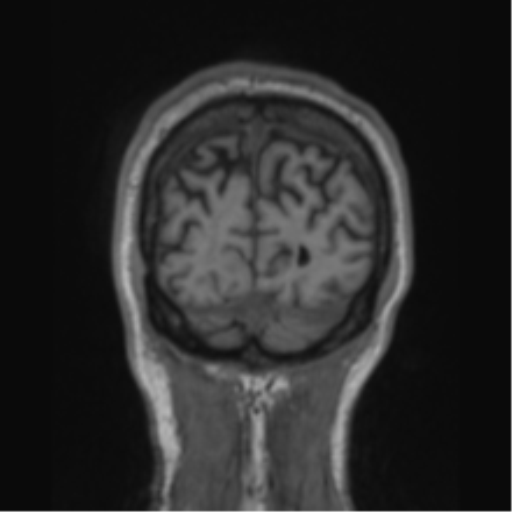 File:Alzheimer's disease- with apraxia (Radiopaedia 54763-61011 Coronal T1 16).png