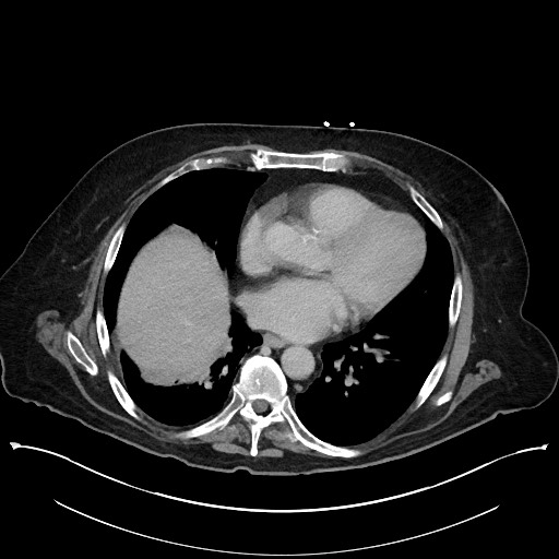 Ampullary adenocarcinoma (Radiopaedia 59373-66737 A 13).jpg