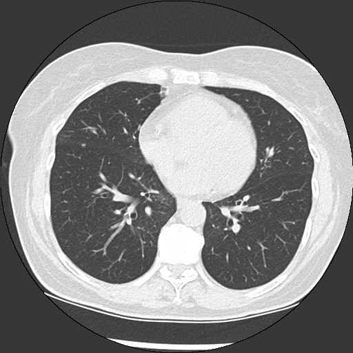 Amyloidosis - bronchial and diffuse nodular pulmonary involvement (Radiopaedia 60156-67744 B 36).jpg