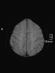 File:Amyotrophic lateral sclerosis (Radiopaedia 70821-81017 Axial SWI minIP 40).jpg