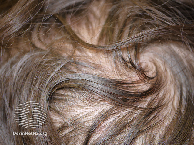File:Anagen effluvium- lupus erythematosus (DermNet NZ hair-nails-sweat-anagen-effluvium-07).jpg