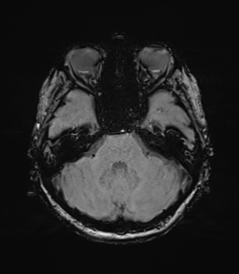 Anaplastic astrocytoma (Radiopaedia 86943-103160 Axial SWI 28).png