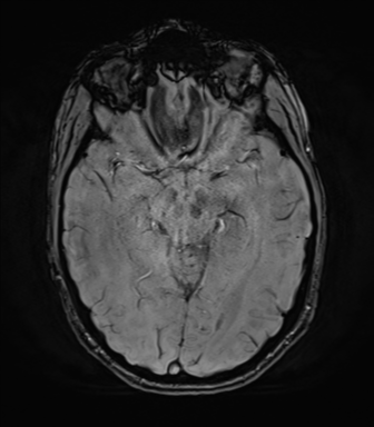 File:Anaplastic astrocytoma IDH mutant (Radiopaedia 50046-55341 Axial SWI 38).png