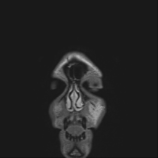 Anaplastic astrocytoma IDH mutant (Radiopaedia 50046-55341 Coronal FLAIR 60).png