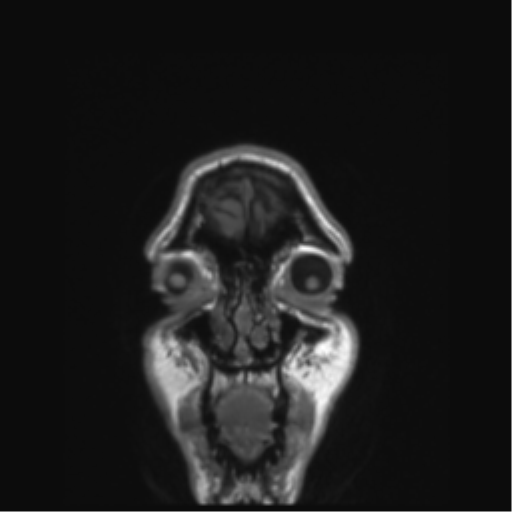 Anaplastic astrocytoma IDH mutant (Radiopaedia 50046-55341 Coronal T1 58).png