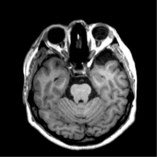 Anaplastic astrocytoma IDH wild-type (pseudoprogression) (Radiopaedia 42209-45277 Axial T1 45).png