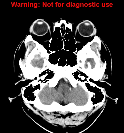 File:Anaplastic ganglioglioma (Radiopaedia 44921-48815 B 5).jpg