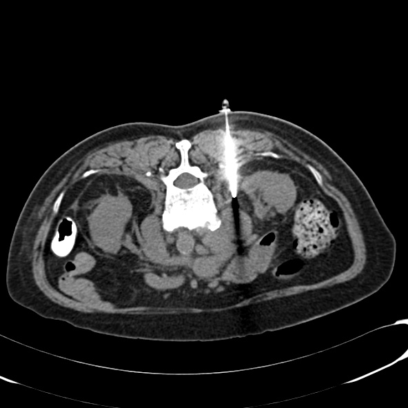 File:Anaplastic lymphoma - with CT biopsy (Radiopaedia 21643-21603 Axial non-contrast 6).jpg