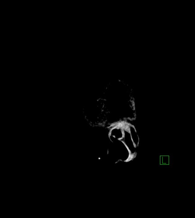 Anaplastic oligodendroglioma (Radiopaedia 79571-92753 C 54).jpg