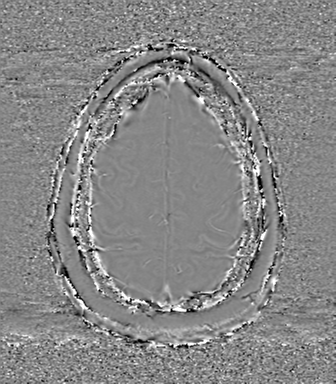 Anaplastic oligodendroglioma (Radiopaedia 83500-98599 Axial SWI - phase 72).png