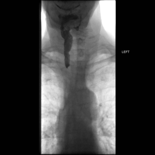 File:Anastomotic stricture post Ivor Lewis esophagectomy (Radiopaedia 47937-52715 Frontal 3).png