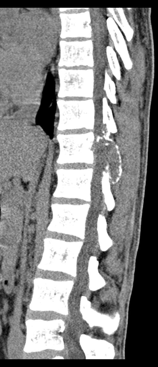 Aneurysmal bone cyst T11 (Radiopaedia 29294-29721 E 44).jpg