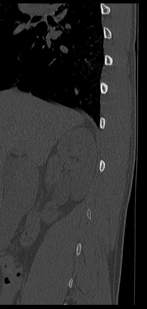 Aneurysmal bone cyst T11 (Radiopaedia 29294-29721 Sagittal bone window 69).jpg