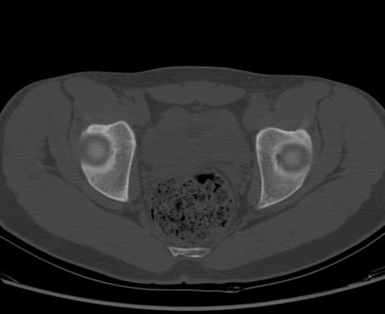 File:Aneurysmal bone cyst of ischium (Radiopaedia 25957-26094 Axial bone window 51).png