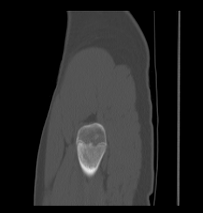 File:Aneurysmal bone cyst of ischium (Radiopaedia 25957-26094 Sagittal bone window 6).png