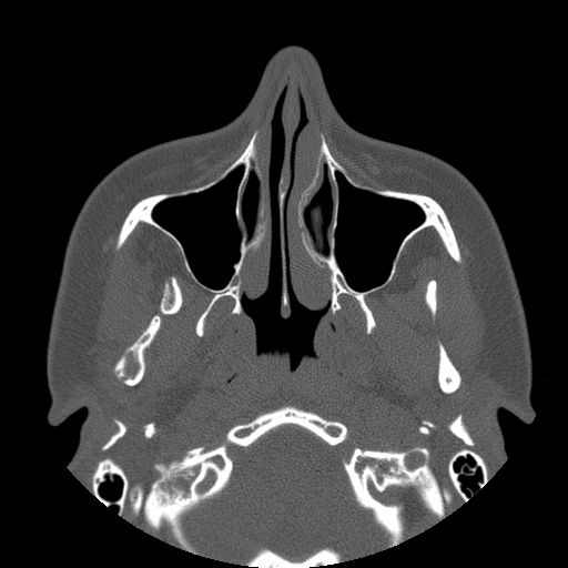 Aneurysmal bone cyst of the mandible (Radiopaedia 43280-46823 Axial bone window 122).jpg