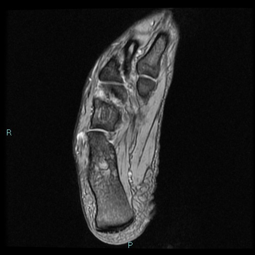 Ankle ganglion cyst (Radiopaedia 62809-71162 Axial Gradient Echo 17).jpg