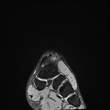 Ankle syndesmotic injury (Radiopaedia 69066-78837 Coronal PD fat sat 50).jpg