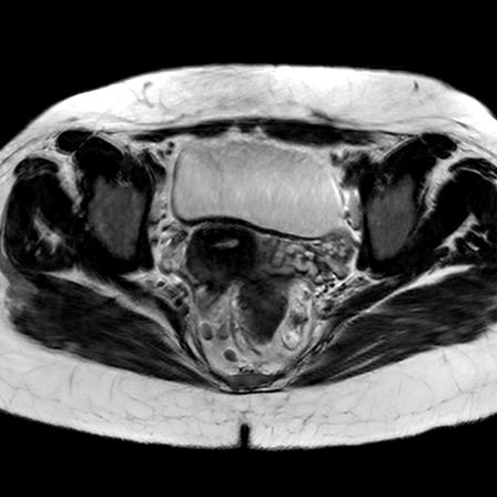 File:Ano-vaginal fistula (Radiopaedia 29765-30284 Axial T2 17).jpg