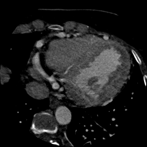 Anomalous left coronary artery from the pulmonary artery (ALCAPA) (Radiopaedia 40884-43586 A 65).jpg
