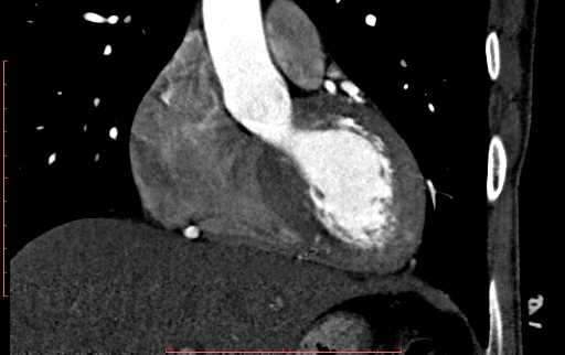 Anomalous left coronary artery from the pulmonary artery (ALCAPA) (Radiopaedia 70148-80181 B 118).jpg