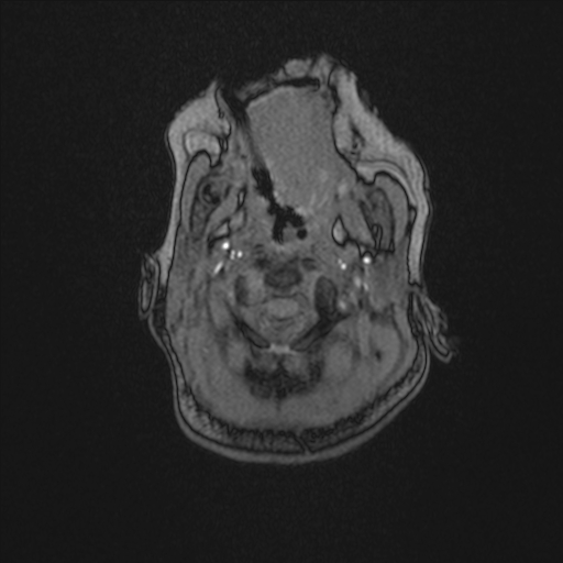 Anoxic brain injury (Radiopaedia 79165-92139 Axial MRA 4).jpg