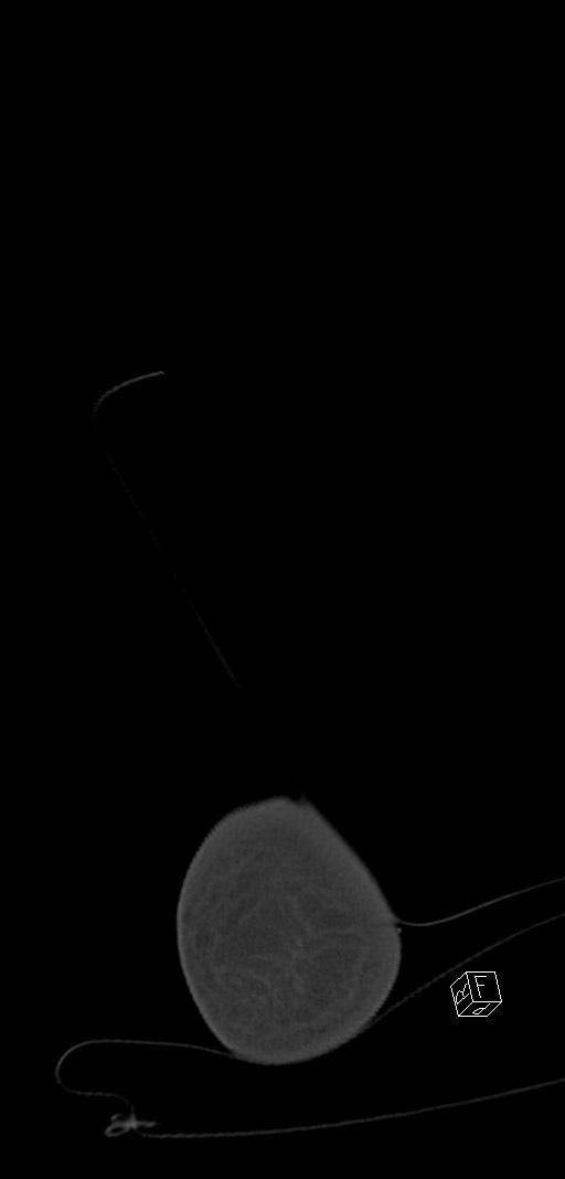 Anterior calcaneal process fracture (Radiopaedia 63353-71943 Coronal bone window 58).jpg