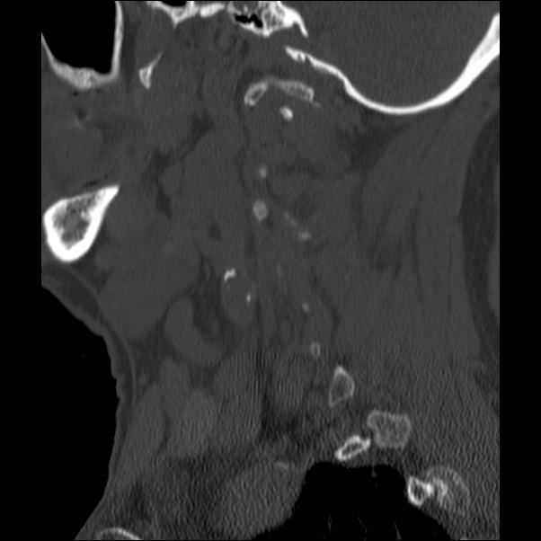 Anterior cervical postdiscectomy arthrodesis (Radiopaedia 32678-33646 Sagittal bone window 11).jpg
