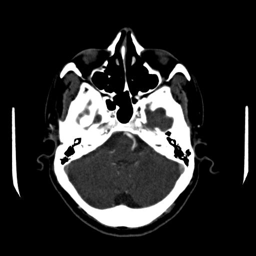 File:Anterior communicating artery aneurysm (Radiopaedia 16633-16335 A 9).jpg