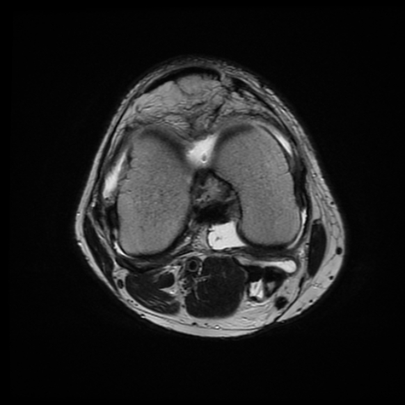 File:Anterior cruciate ligament graft tear and bucket-handle tear of medial meniscus (Radiopaedia 75867-87255 Axial T2 11).jpg