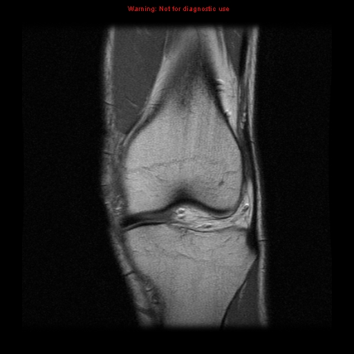 File:Anterior cruciate ligament injury - partial thickness tear (Radiopaedia 12176-12515 Coronal PD 6).jpg