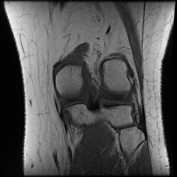 File:Anterior cruciate ligament tear, Wrisberg rip and bucket-handle tear of medial meniscus (Radiopaedia 75872-87266 Coronal T1 20).jpg