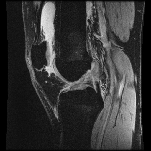 Anterior cruciate ligament tear (Radiopaedia 61500-69462 F 44).jpg