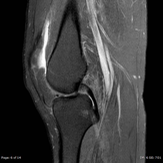 File:Anterior cruciate ligament tear (Radiopaedia 70783-80964 Sagittal PD fat sat 6).jpg