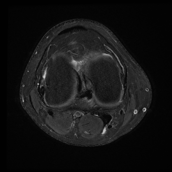 File:Anterior cruciate ligament tear with posteromedial corner injury, bucket-handle meniscal tear and chondral delamination (Radiopaedia 75501-86744 Axial PD fat sat 11).jpg