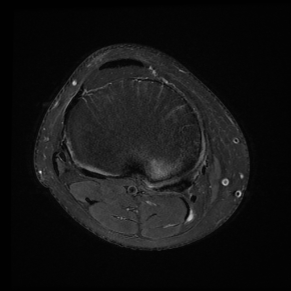 File:Anterior cruciate ligament tear with posteromedial corner injury, bucket-handle meniscal tear and chondral delamination (Radiopaedia 75501-86744 Axial PD fat sat 6).jpg