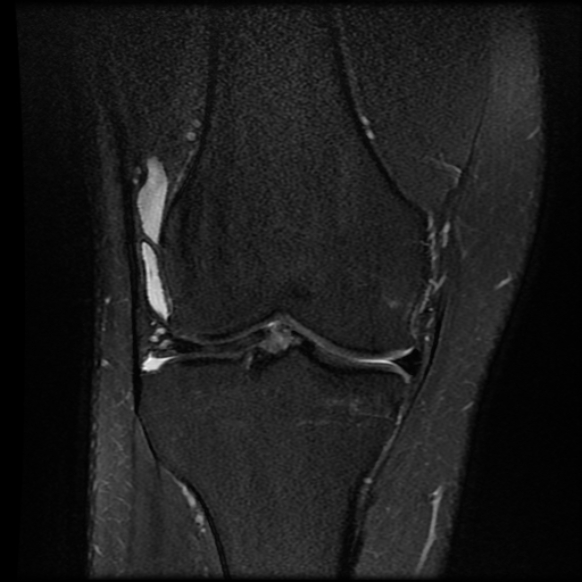File:Anterior cruciate ligament tear with posteromedial corner injury, bucket-handle meniscal tear and chondral delamination (Radiopaedia 75501-86744 Coronal PD fat sat 12).jpg