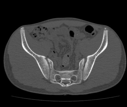 File:Anterior inferior iliac spine avulsion fracture (Radiopaedia 81312-94999 Axial bone window 34).jpg